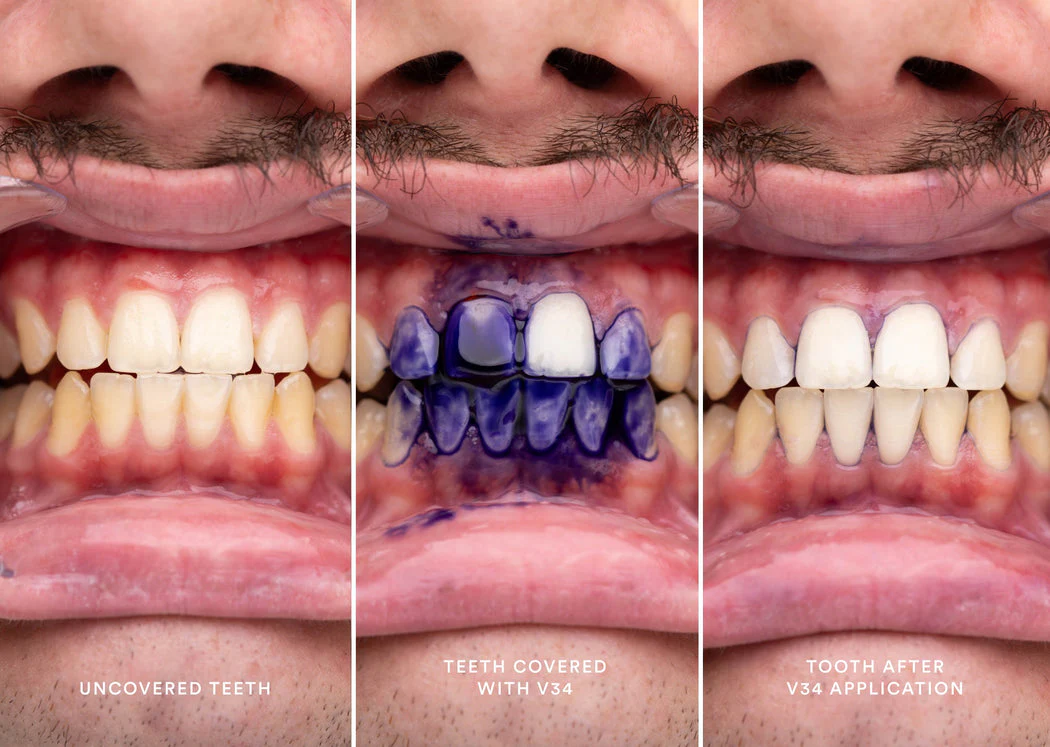 Hismile v34 Colour Corrector Serum Purple Teeth Whitening & Stain Removal - Image 4