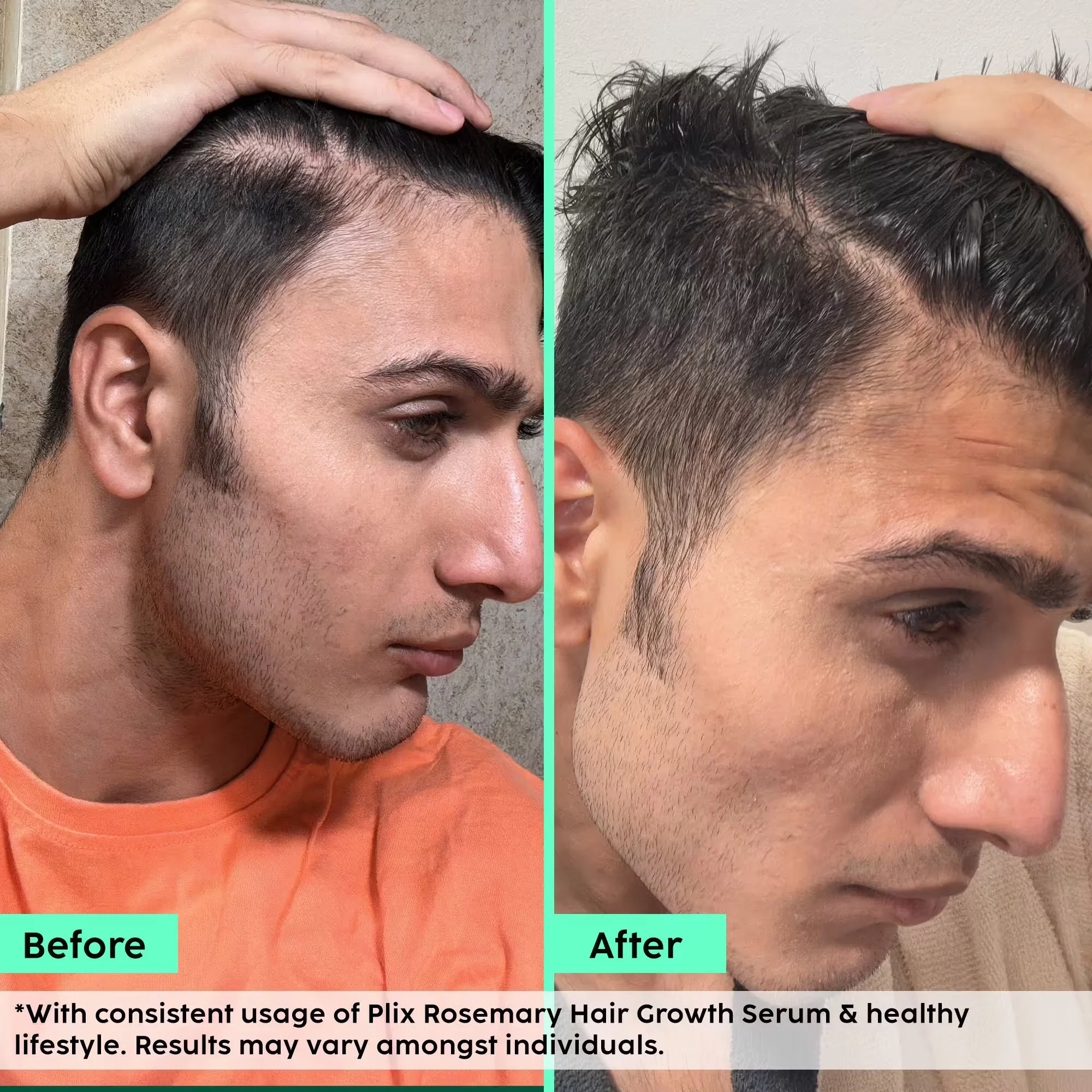 Rosemary Advanced Hair Growth Serum for Pattern Baldness | Promotes New Hair Growth - Image 2